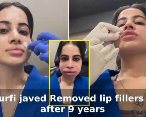 urfi javed removed lip fillers after 9 years