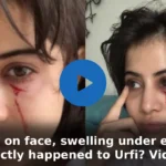 Blood on face, swelling under eyes; What exactly happened to Urfi? Video viral