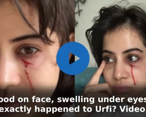 Blood on face, swelling under eyes; What exactly happened to Urfi? Video viral