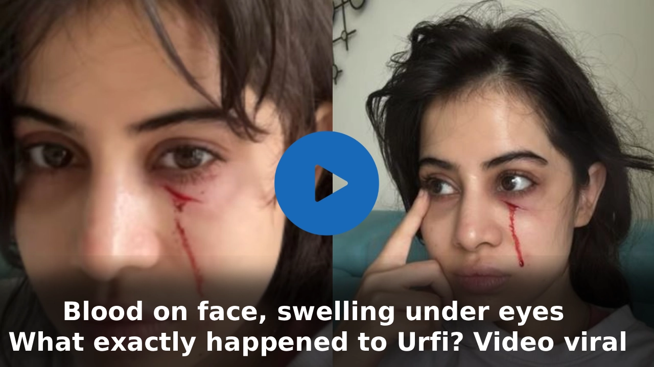 Blood on face, swelling under eyes; What exactly happened to Urfi? Video viral